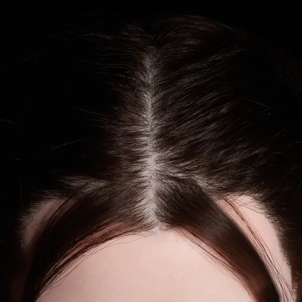 Cheveux implantés